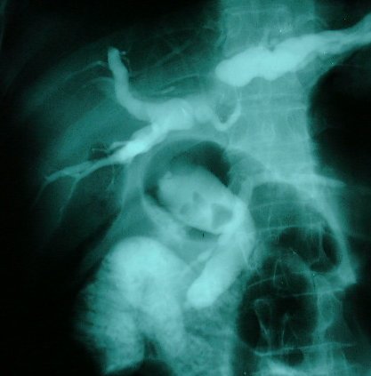 ȨⰡ ó ü ERCP 
