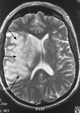 ޼  MRI 